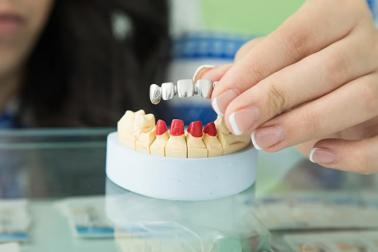 The Advantages of All-on-4 Implants in Weyers Cave, VA | The Busines Mark