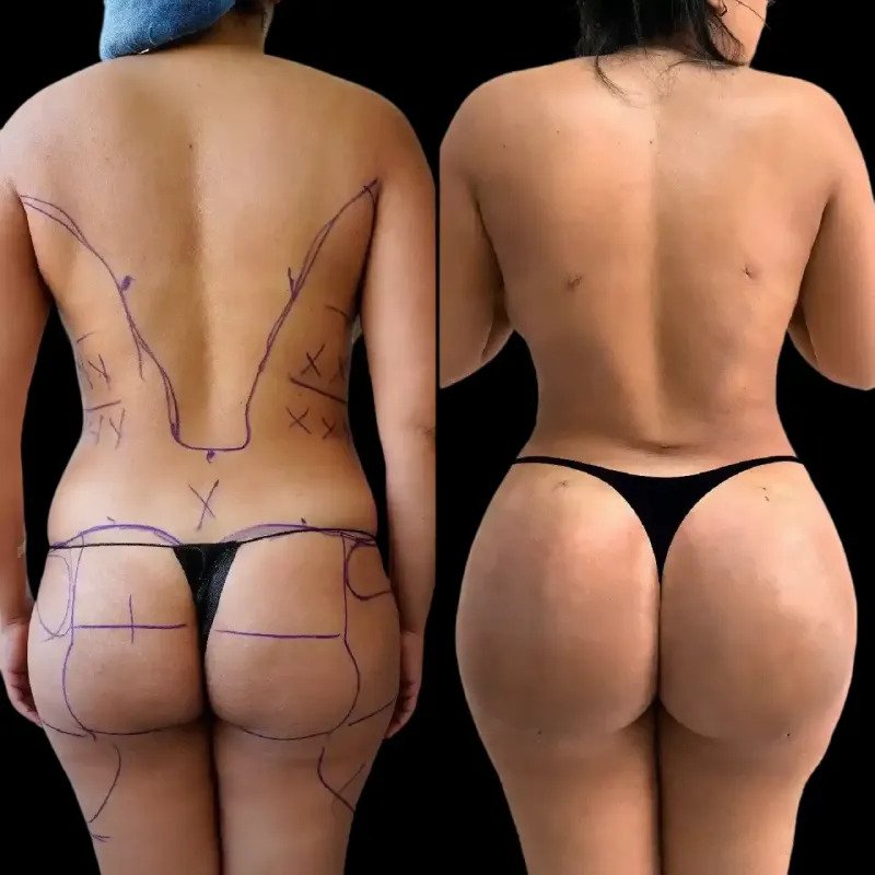 Why Dubai Is A Hub For Buttock Augmentation Procedures - TIMES OF RISING