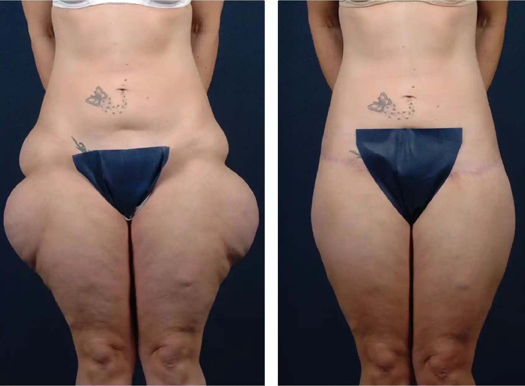 Technology: Innovations in Thigh Lift Techniques in Dubai