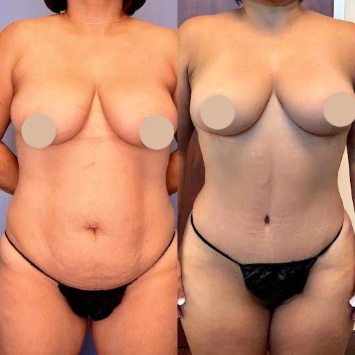 Body Contouring Techniques: Traditional to 360 Procedures