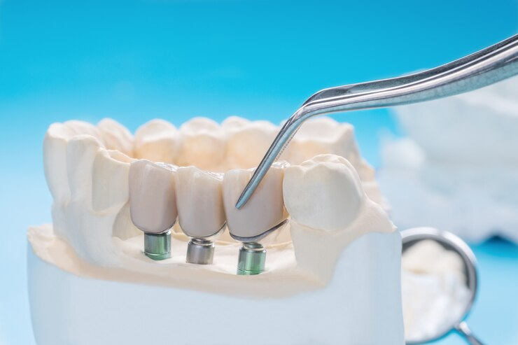 The Ins and Outs of Dental Implants: A Modern Solution for Missing Teeth | New York Times Now