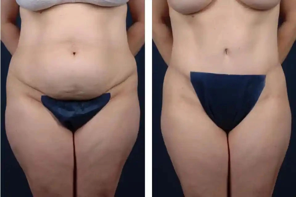 Tummy Tuck in Dubai: The Importance of Post-Operative Care -