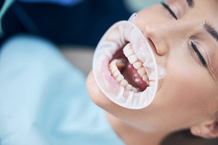Full Mouth Restoration: Transforming Your Oral Health