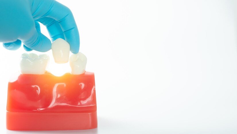 Understanding Dental Bridges Parts that Make Up Bridges