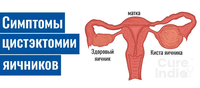 Понимание гистерэктомия матки и цистэктомия яичника лапароскопия: Руководство по женскому здоровью — блог туриста riosmith на Туристер.Ру