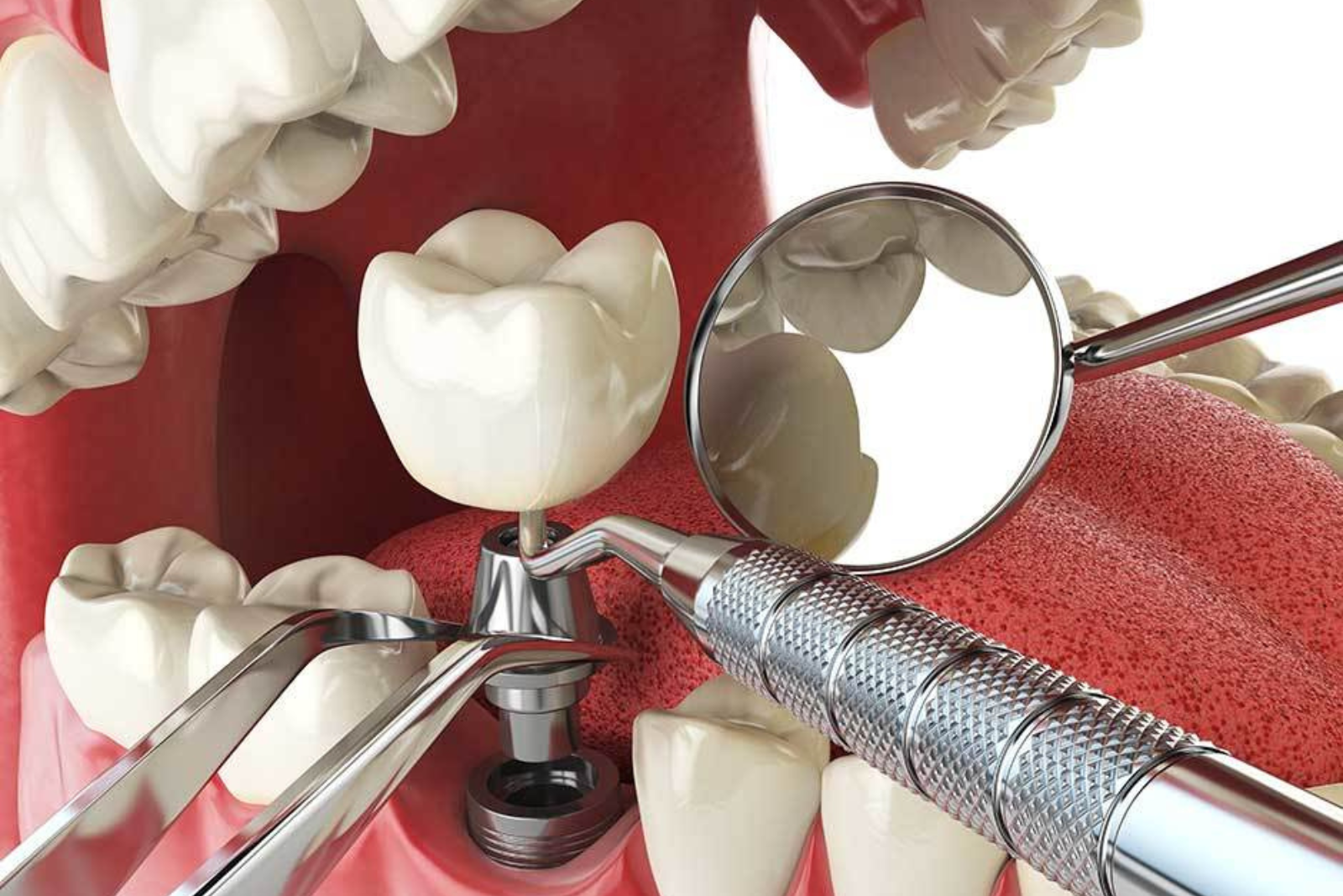 Top Benefits Of Getting Tooth Implants For Missing Teeth