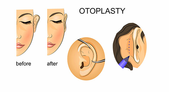 Otoplasty Surgery | Ear Reshaping Surgery - Dr Rajat Gupta