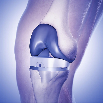 Total Knee Replacement in Islamabad Rawalpindi & Pakistan