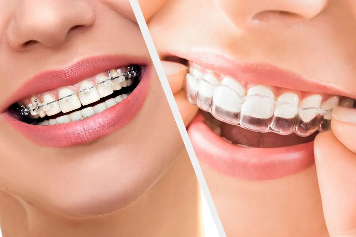 Braces for Teeth in RR Nagar. When most people think of orthodontics… | by Symphonysmiles | Jul, 2025 | Medium