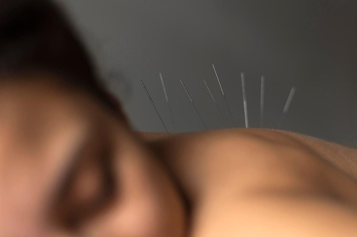 Holistic Healing with Acupuncture in Frederick, MD – Ellicott Acupuncture Centre