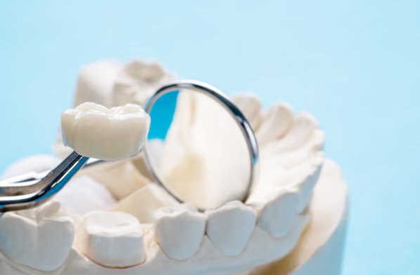 Tooth Replacement with Dental Bridges: A Comprehensive Overview