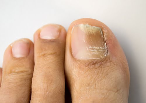 Fungal toenails, medically known as onychomycosis.