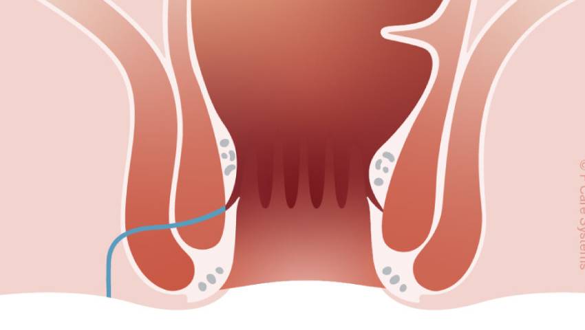 How to Cure Fistula Permanently | Dr. Raviram S.