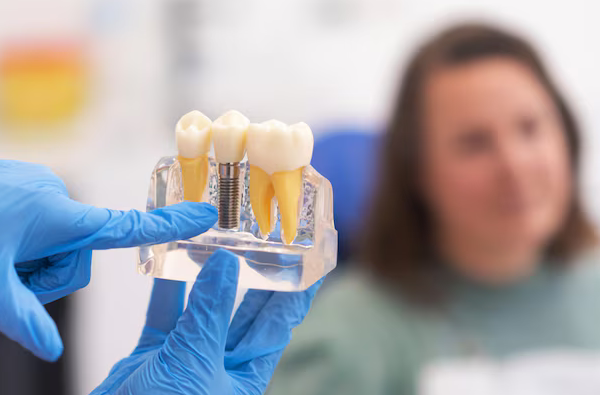 Dental Implants - Closest Thing to a Natural Tooth Replacement Option