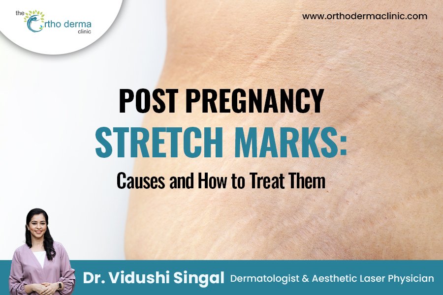 Post Pregnancy Stretch Marks: Causes & Best Treatments