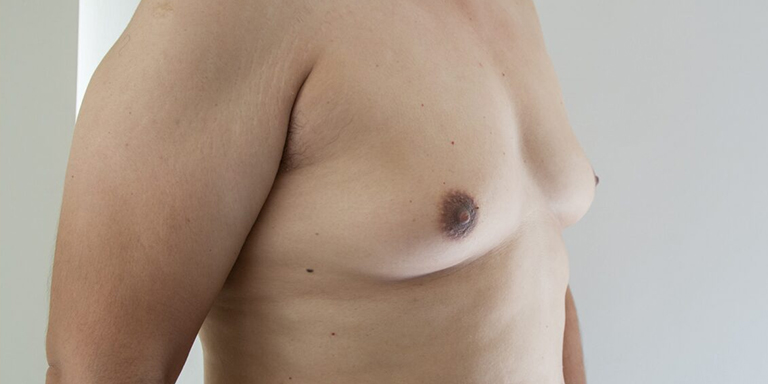 Can You Treat Gynecomastia Without Surgery?