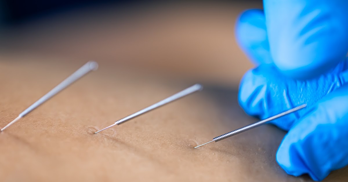Can Acupuncture Spark a New You in Frederick, MD?