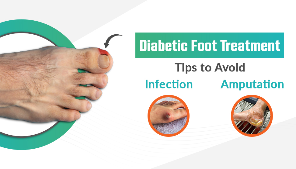 Diabetic Foot Treatment - Olwen Hospital