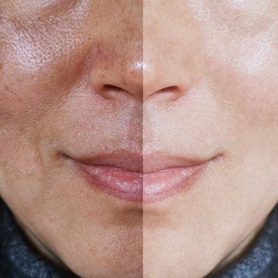 Melasma Treatment in Islamabad- ERCs