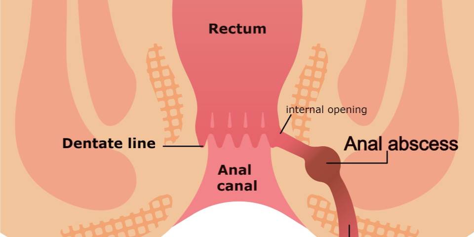 Best Fistula Treatment in Bangalore | Best Fistula Specialist : Dr. Bhushan Chittawadagi