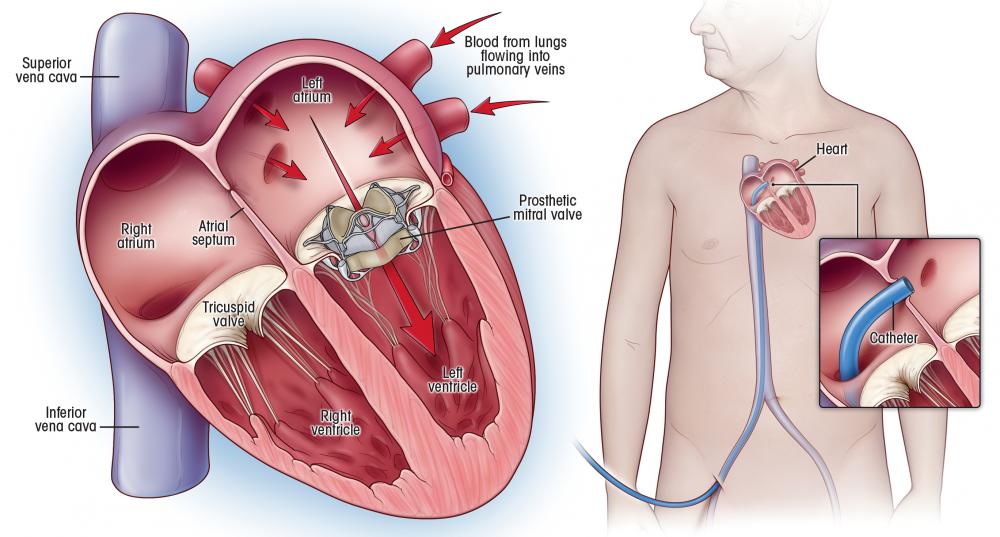 Transcatheter Aortic Valve Replacement in Lucknow