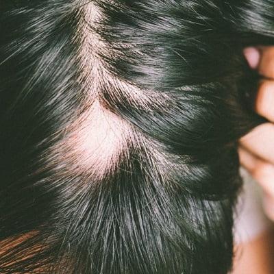 Alopecia Areata Treatment in Islamabad - Enfield Royal Clinics