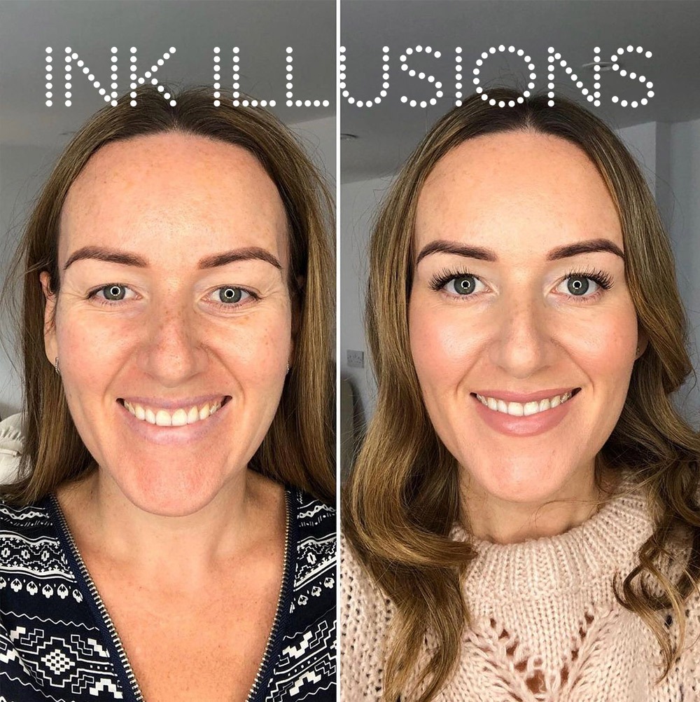 The Best RF Microneedling Treatments in London for Lasting Skin Rejuvenation - Genius Vision