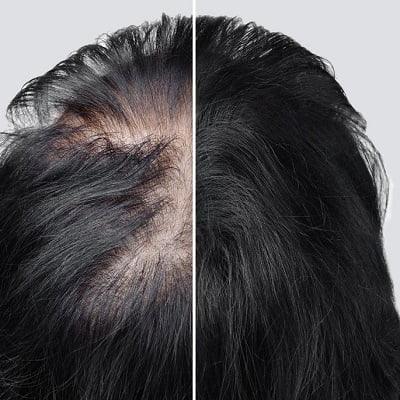 Exosome Hair Therapy in Islamabad Pakistan