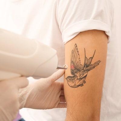 Laser Tattoo Removal in Islamabad Pakistan - ERCs