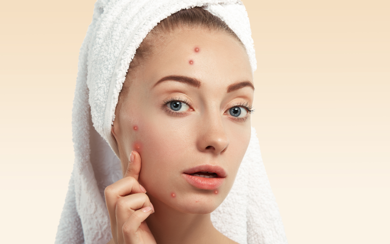 Get Best Acne Treatment Dermatologist in Paterson New Jersey