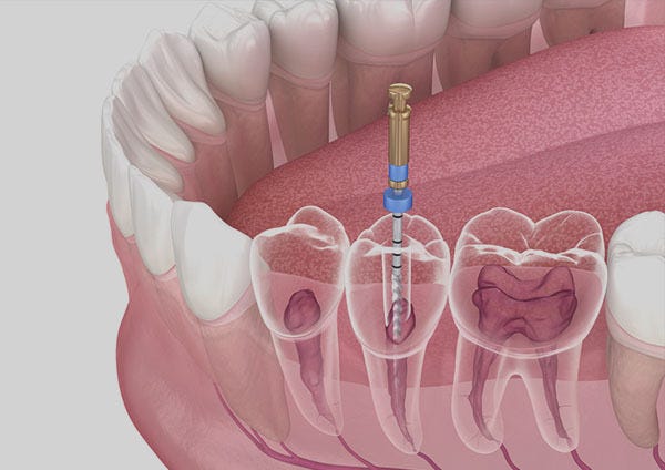 Root Canal Treatment in RR Nagar. One of the most common yet critical… | by Symphonysmiles | Sep, 2025 | Medium
