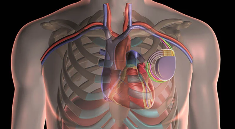 Cardiac resynchronization therapy | Dr. Ritesh Kumar Pandey