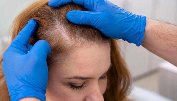 Alopecia Areata Treatment by Hair Loss Dermatologist in NJ