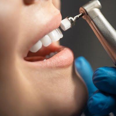 Teeth Scaling Treatment in Islamabad- Cost & Results -ERCs