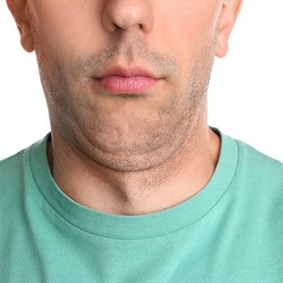 Double chin treatment in Islamabad Pakistan - ERCs