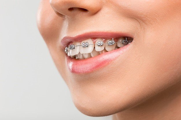 Braces and Jaw Alignment: How Orthodontics Can Improve More Than Just Teeth
