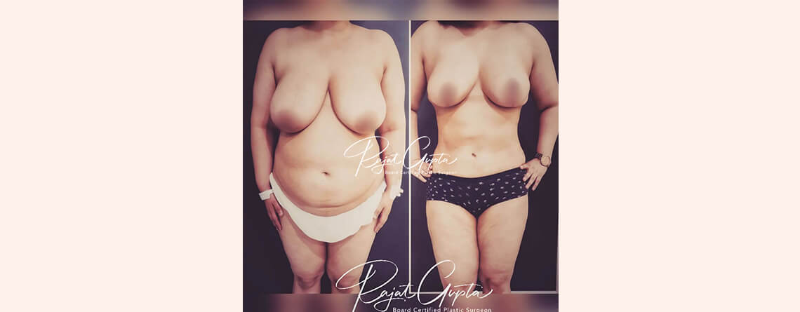 RG Flap Technique Surgery vs. Other Breast Reduction Methods