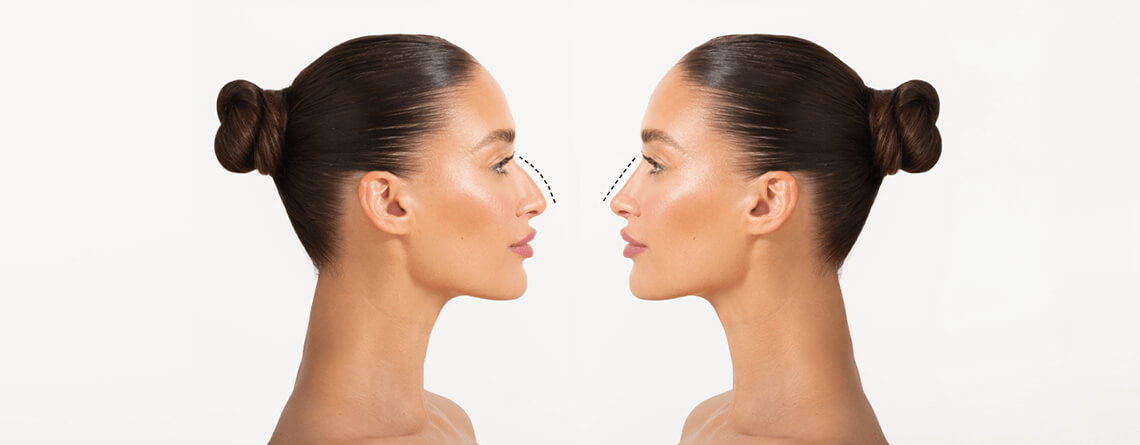 Rhinoplasty Surgery: Nose Reshaping Explained