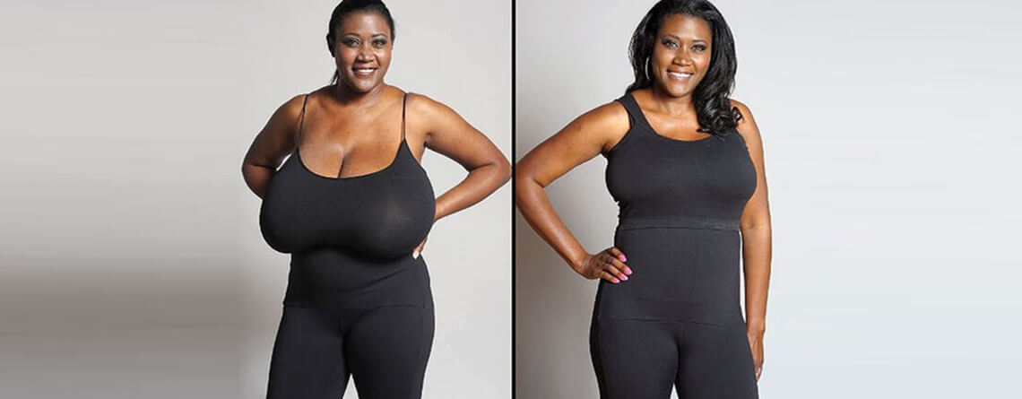 RG Flap Technique Surgery: Innovative Breast Reduction Surgery