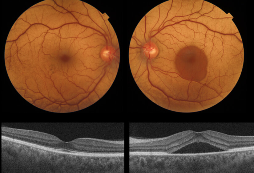 Central Serous Retinopathy Treatment: A Complete Guide
