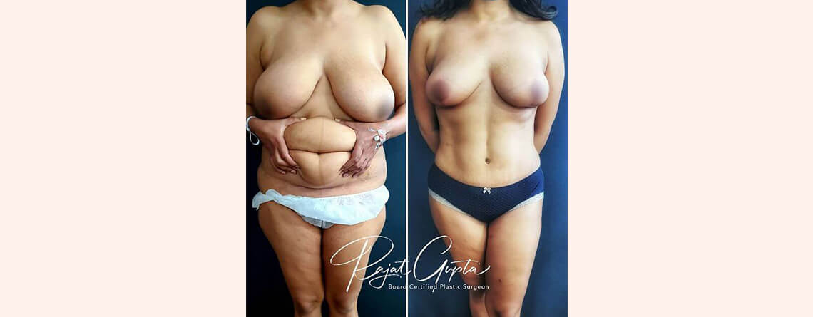 Virtual Consultations for Tummy Tuck Surgery | Dr Rajat Gupta