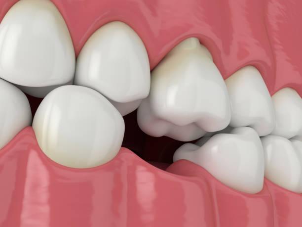 Why Are Oral Surgeons Recommending Impacted Canine Surgery More Often?