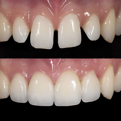 Dental Bonding in Islamabad, Pakistan