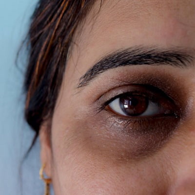 Dark Circles Treatment in Islamabad, Rawalpindi & Pakistan