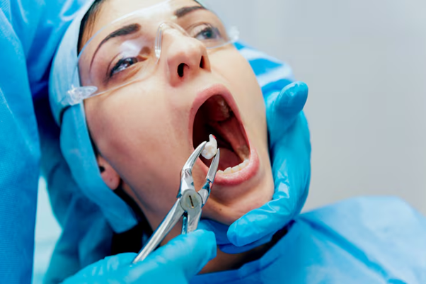 Tooth Extraction Myths vs. Facts: What You Really Need to Know