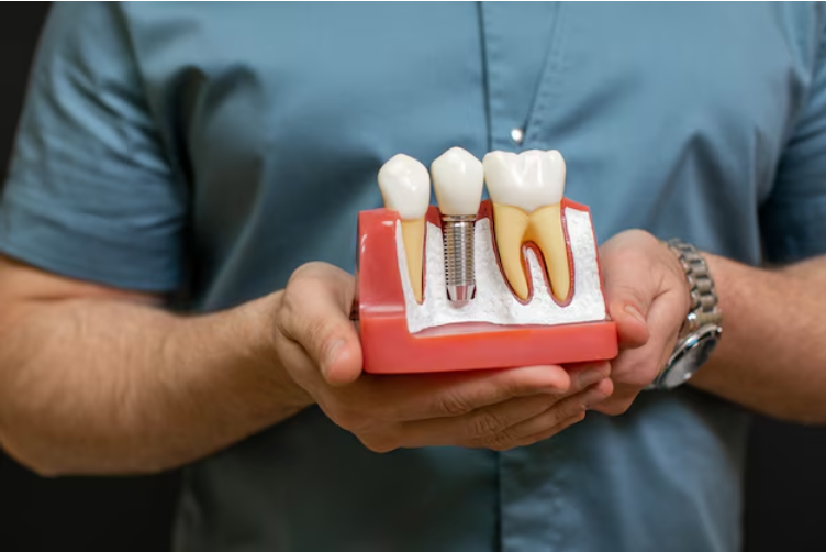 How Dental Implants Work: Step-by-Step Process Explained - Rawnak AlRigga