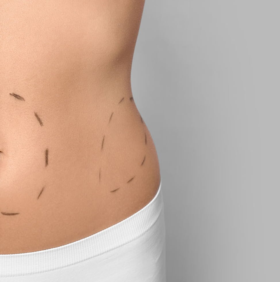 Tummy Tuck Surgery in Delhi - Dr Monisha Kapoor