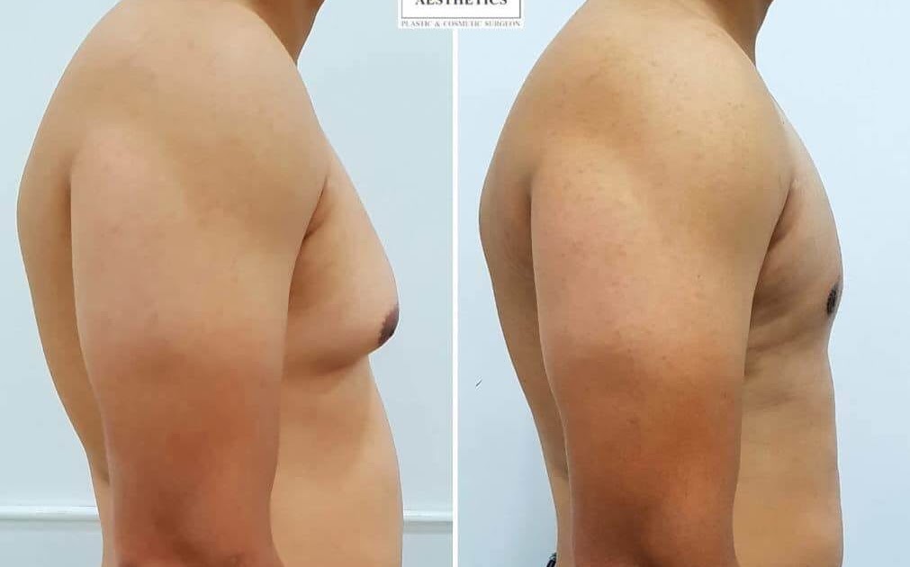 How Do I Know If I Have Gynecomastia?