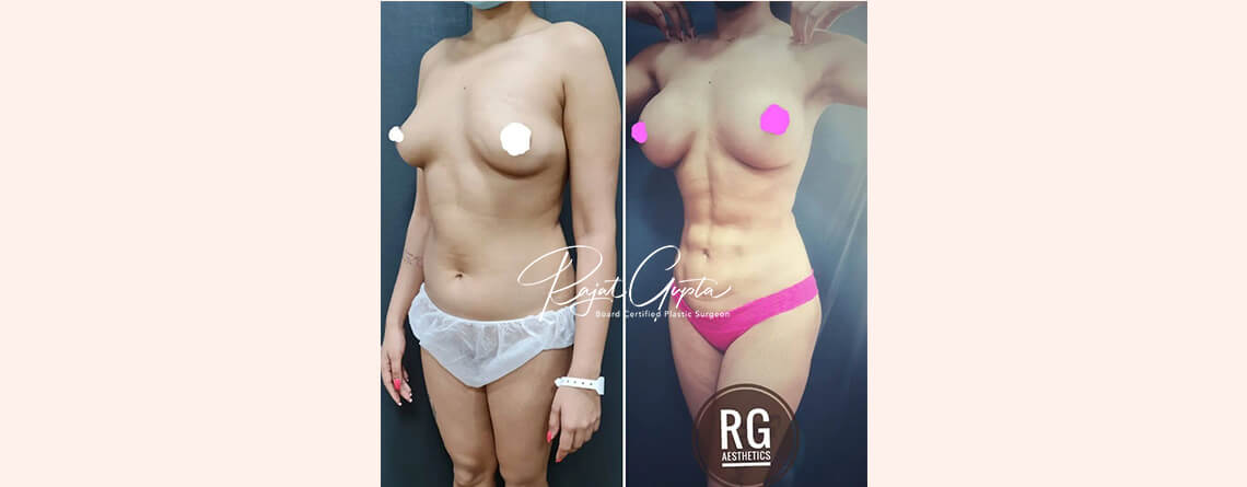 Liposuction Surgery in Delhi: Choosing the Right Surgeon