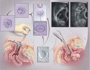 Best IVF Treatment Cost in Delhi | Affordable IVF Clinic & Packages